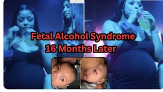 Understanding the Impact Fetal Alcohol Syndrome and Potential Paralysis in Chrisean Son Jr [upl. by Kenwee]