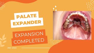 Palate Expansion Complete Treating Idiopathic Condylar Resorption [upl. by Derk515]