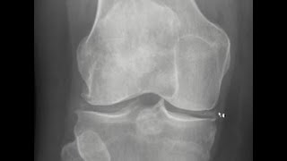 Chondrocalcinosis of the knee [upl. by Hoo]