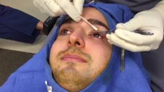 Eyelid Ptosis  Droopy Eyelid Surgery  Hidden Incision [upl. by Teyut]