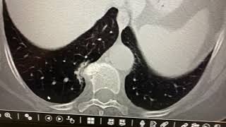 Osteophyte induced pulmonary atelectasis [upl. by Yanal]