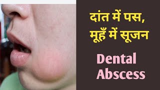 दांत में पस सूजन मवाद पस कारणइलाज Tooth Abscess Mouth Swelling pus reason and its treatment [upl. by Esile]