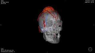 Parasagittal tumor with sagittal sinus invasion [upl. by Normandy]