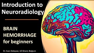 Imaging of Spontaneous Brain Hemorrhage the basics [upl. by Tawney670]