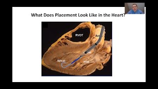 Echocardiographic Assessment of Impella Placement [upl. by Ube]