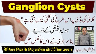 Ganglion Cysts کلائی پہ گلٹی Homeopathic Treatment By Dr Waqar Bhutta In Urdu  Hindi [upl. by Adianez917]