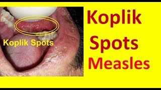 Koplik Spots in Measles [upl. by Alessandro112]