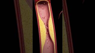 Atherosclerosis is a hardening of your arteries form plaque building biology relatable plauge [upl. by Enawd250]