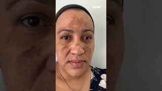 Get beautiful skin without dark spots by using Renewal Face Cream darkspots darkspotsolution [upl. by Dougherty432]