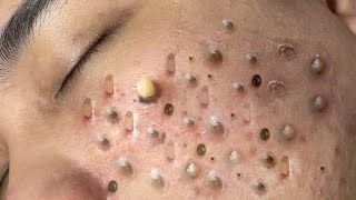 ACNE TREATMENT VU QUYNH MI Blackheads Removal Popping [upl. by Nipha879]