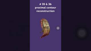 35 distal root caries [upl. by Aiveneg]