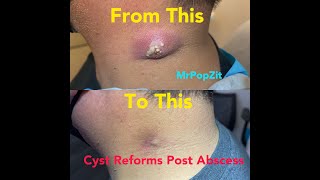 Cyst reforms months after Incision amp Drainage of large neck abscess Removal and dissection today [upl. by Annaik260]