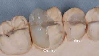 Restaurações em Resina Composta Indireta [upl. by Moffit973]