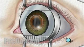 Patient Education Laser Eye LASIK Surgery PreOp® Patient Engagement [upl. by Adym]