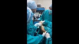 Liposuccion asistida por laser laser lipolisis Brazos El Salvador [upl. by Hofmann]