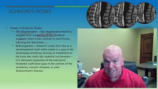 QME Clinical Rounds Schmorls Nodes Perry J Carpenter DC QME wwwezcontnuingeducationorg [upl. by Elisha]