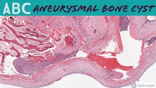 Aneurysmal Bone Cyst ABC 5Minute Pathology Pearls [upl. by Arehsat]