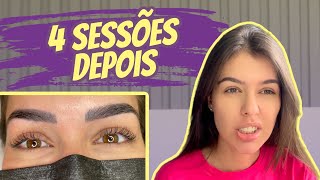 DESPIGMENTAÇÃO DE SOBRANCELHA MINHA EXPERIÊNCIA  ANTES E DEPOIS [upl. by Eesdnyl]