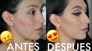 COMO CUBRIR ACNE OJERAS MANCHAS Y MAS CON MAQUILLAJE  PAJARITABELLA [upl. by Einohpets]