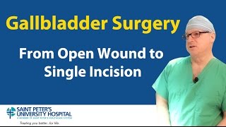 Gallbladder Surgery From Open Wound to Single Incision [upl. by Nnaxor]