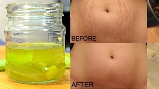 How To Remove Stretch Marks Permanently Works 100  Cure Injury amp Burn In 3 Days Miracle Oil [upl. by Yentnuoc]