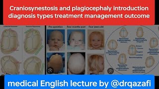 Craniosynestosis and plagiocephaly introduction diagnosis types treatment management outcome [upl. by Eimas]