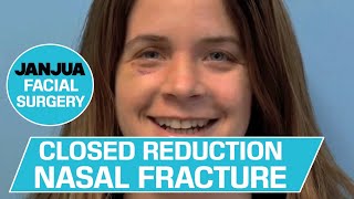 CLOSED REDUCTION NASAL FRACTURE  DR TANVEER JANJUA  NEW JERSEY [upl. by Asenav]