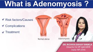 What is Adenomyosis Treatments Symptoms and Causes Dr Richika Sahay Shukla  India IVF Clinic [upl. by Asert432]