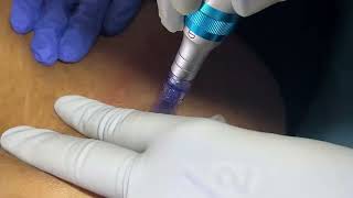 Microneedling with PRP for stretch marks Dr Aiswarya [upl. by Yahc382]