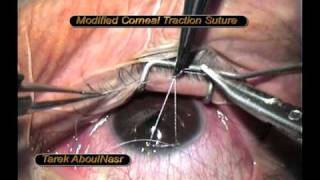 Corneal traction suture in glaucoma modification [upl. by Columbus]