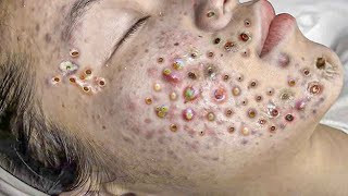 Big Cystic Acne Blackheads Extraction Blackheads amp Milia Whiteheads Removal Pimple Popping  140 [upl. by Latif562]