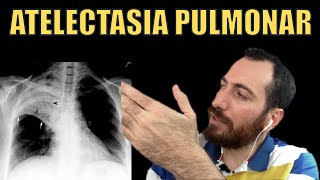 Atelectasia pulmonar [upl. by Ethelstan]