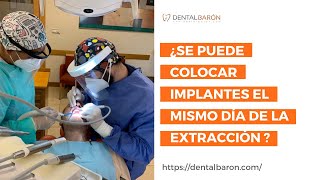 ¿Se puede colocar implantes luego de una extracción dental [upl. by Enyad]