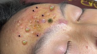 Loan Nguyen Acne spa 259 [upl. by Aleibarg]