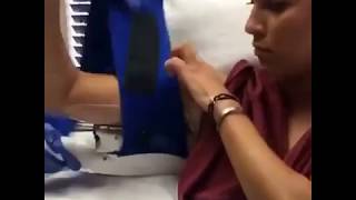 Coolsculpting NonSurgical Fat Reduction of the Upper Arm [upl. by Atnovart]