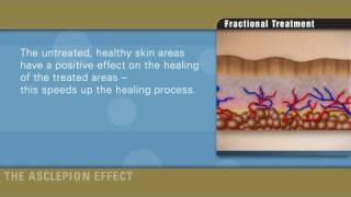 Fractional therapy with Erbium laser by Asclepion [upl. by Hseham871]