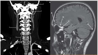 Exam5CNS anatomy with answers frcr anatomy radiopedia radiology MRICTangiographyMRAMRV1 [upl. by Gerdy]