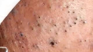 blackheads removal with sac dep spa 2023  satisfing relaxing with sac dep spa 992 [upl. by Othilie]