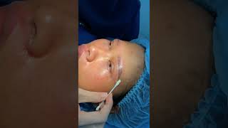 wenkbroue lig laer ooglid chirurgie krimp die philtrum xuhuongyoutube lamdep thongthainguyen [upl. by Stephania]