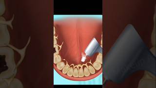 asmr tooth cavities  caries removal treatment [upl. by Dnob127]