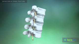 Spinal fractures Definition [upl. by Schoenberg]