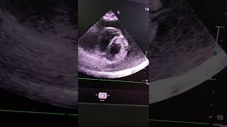 Massive Pericardial EffusionSwinging Heart Sign Clinical Pearl4 [upl. by Thilda]