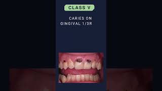 DENTAL CARIES CLASSIFICATION  GV BLACK CLASSIFICATION [upl. by Dnalerb336]