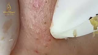 Loan Nguyen Acne Treatment 0288hn [upl. by Mohorva247]