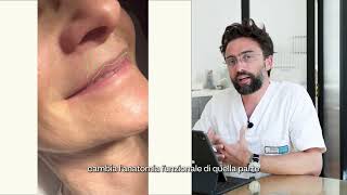 Medicina Estetica Scioglimento Filler  Ialuronidasi  PREPOST  Studio Borbon Milano [upl. by Fauver542]