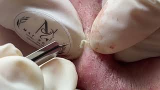 ACNE UNDER THE SKIN  Acne Treatment Mai Ngoc [upl. by Hakon]