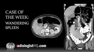 Case of the Week Wandering Spleen CT [upl. by Pruchno]