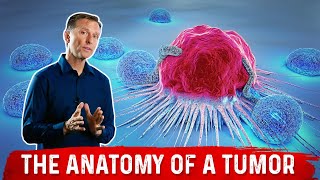 What Causes Tumors Polyps Moles amp Pimples – Dr Berg [upl. by Bugbee]