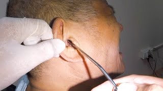 This is How to Remove Mans Rock Hard Earwax [upl. by Araz]