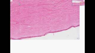 Histopathology Skin kidney Systemic sclerosis scleroderm [upl. by Raleigh]